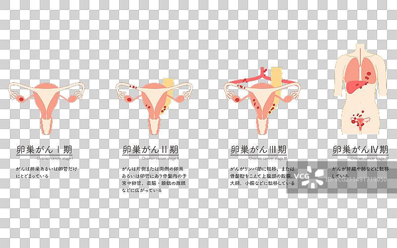 卵巢癌I期解剖结构图图片素材