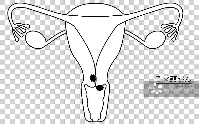 宫颈癌解剖图图片素材