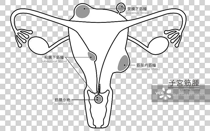 子宫肌瘤解剖图图片素材