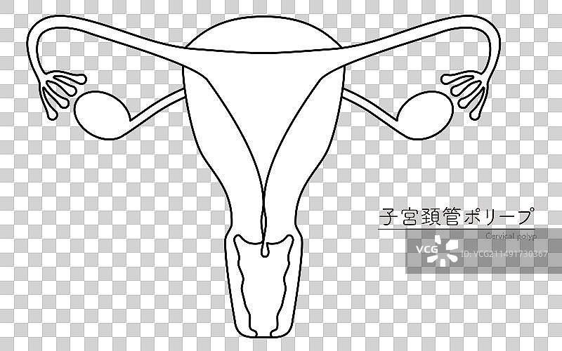 宫颈息肉解剖图图片素材