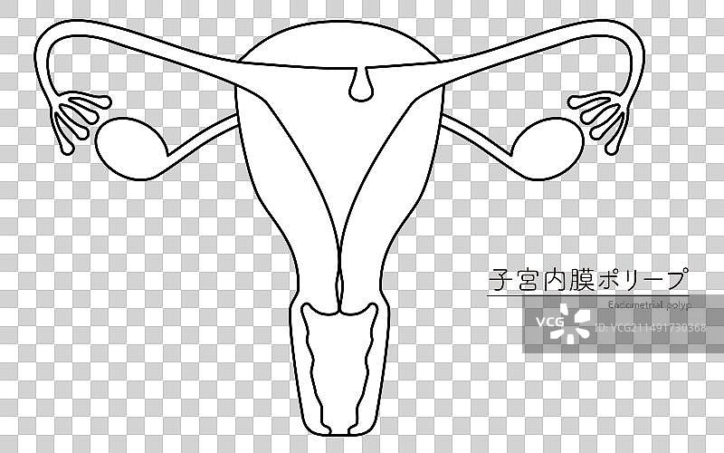 子宫内膜息肉解剖图图片素材