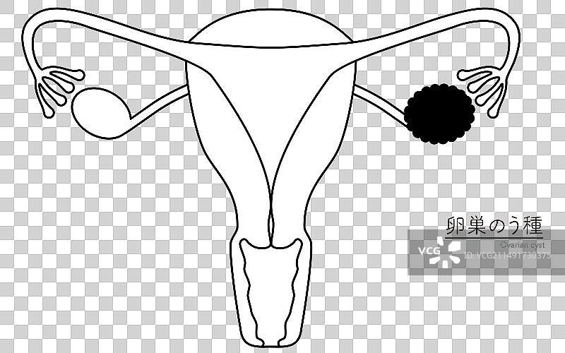 卵巢囊肿解剖示意图图片素材