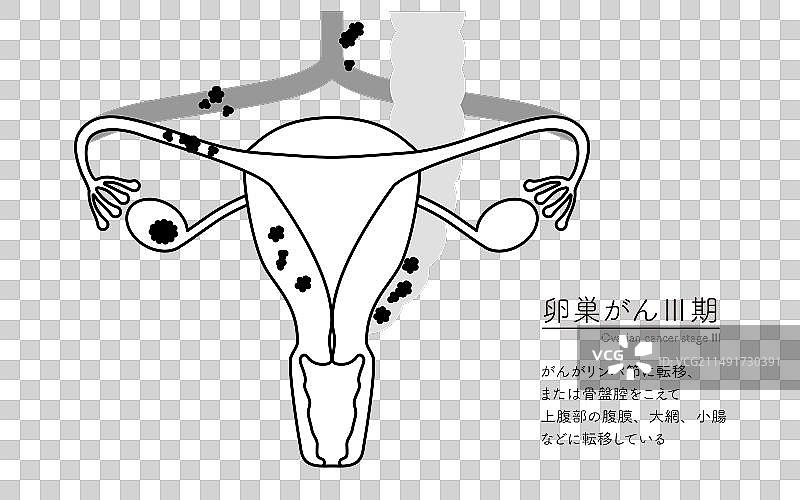 三期卵巢癌解剖结构图示图片素材