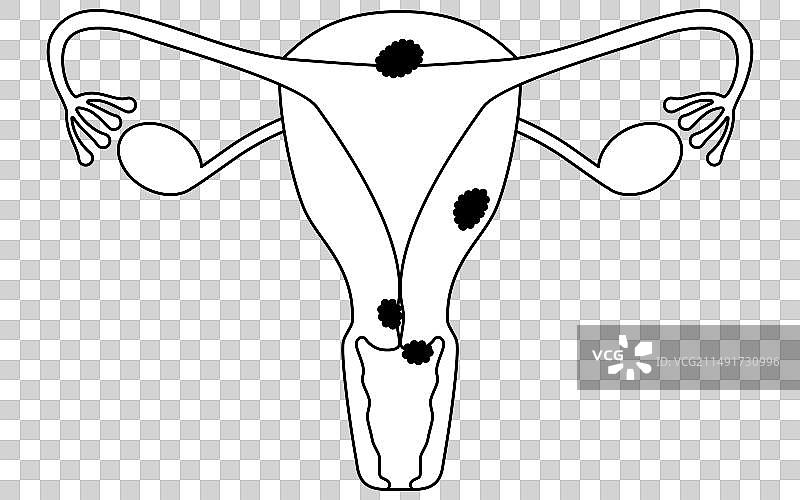 宫颈癌解剖图图片素材