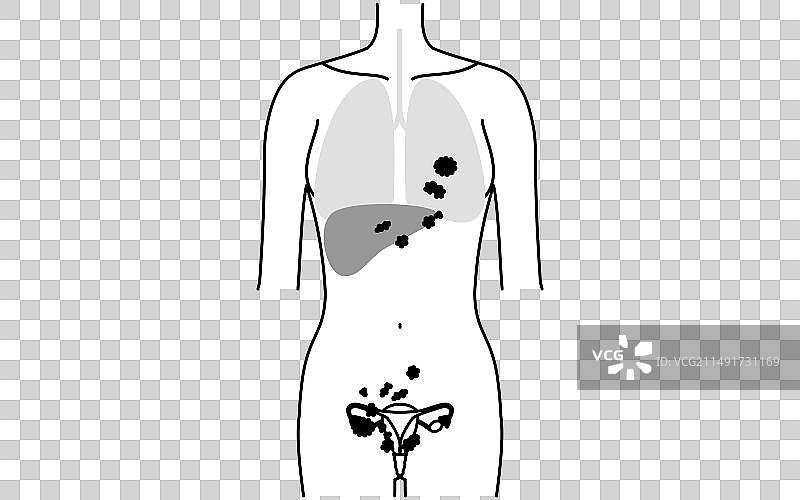 卵巢癌IV期解剖结构图解图片素材