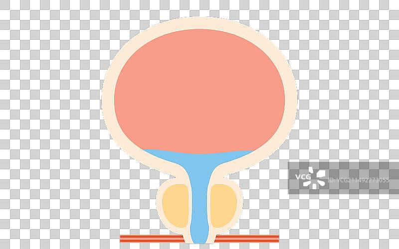 良性前列腺增生医疗图片素材