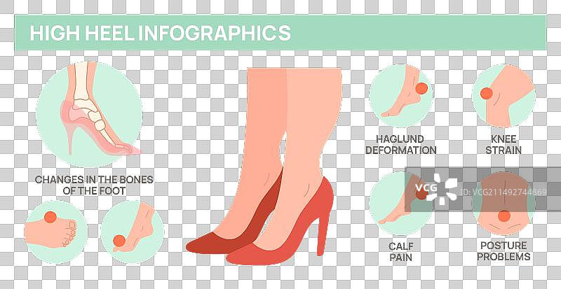高跟鞋对女性足部疾病的危害图片素材