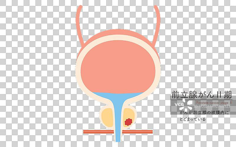 前列腺癌二期医疗图图片素材