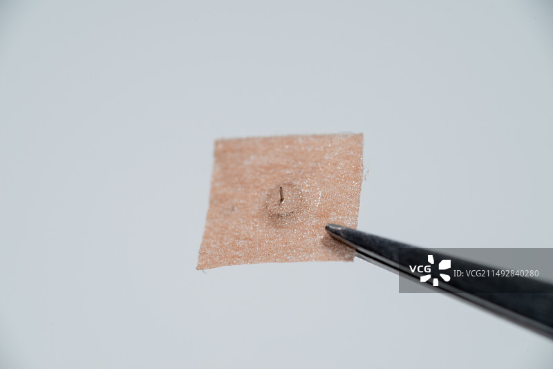 揿针也叫皮内针、耳针，是一种带针的针灸贴，用于临床治疗内外妇儿的疾病，中医辅助治疗法图片素材