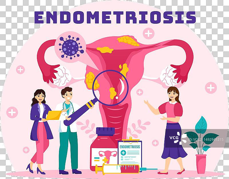 子宫内膜异位症与子宫内膜图片素材