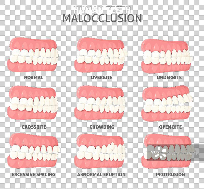 牙科医疗中的错颌畸形类型侧视图图片素材