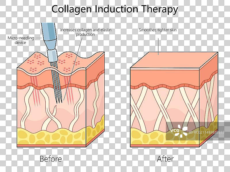 胶原蛋白诱导疗法前后对比图图片素材