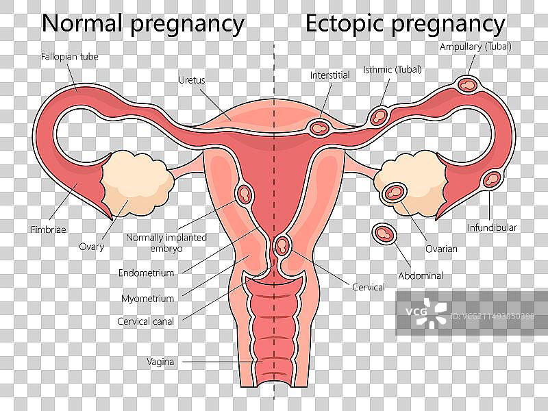 正常妊娠与异位妊娠医学图片素材