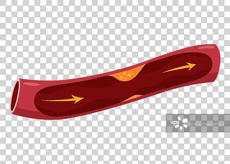 动脉粥样硬化心脏病发作解剖图图片素材