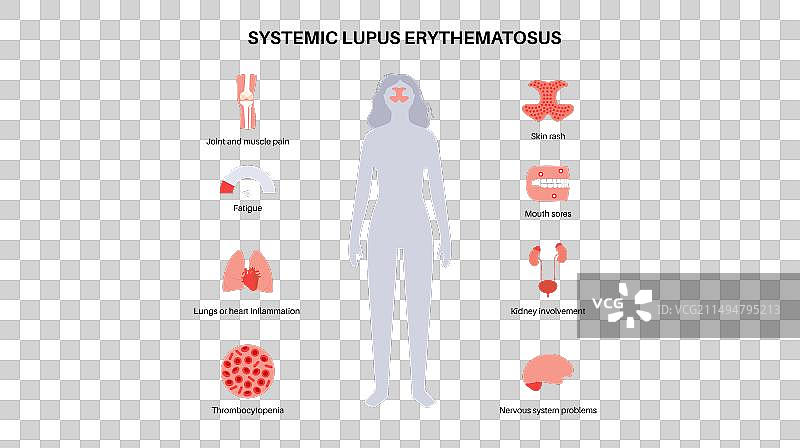 系统性红斑狼疮图片素材