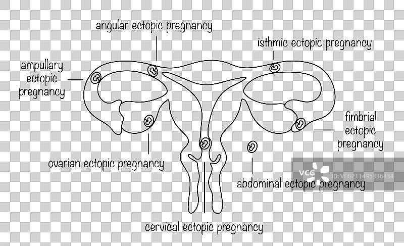 宫外孕图片素材