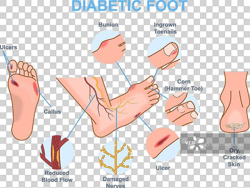 糖尿病足医学图图片素材