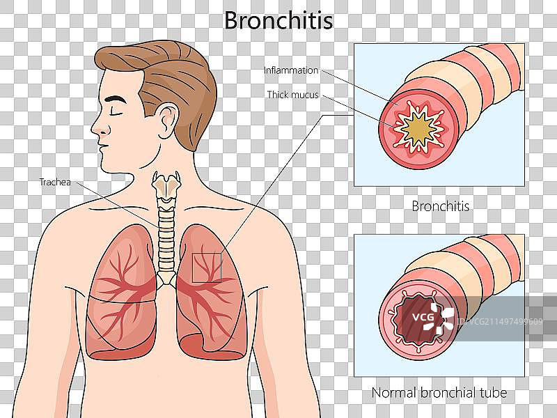 支气管炎影响的气道医学图图片素材