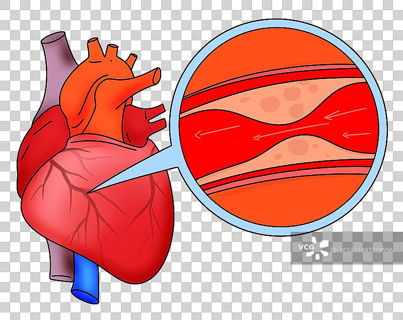 血管，动脉硬管，心脑血管疾病，血栓，描边风格简笔画设计元素图片素材