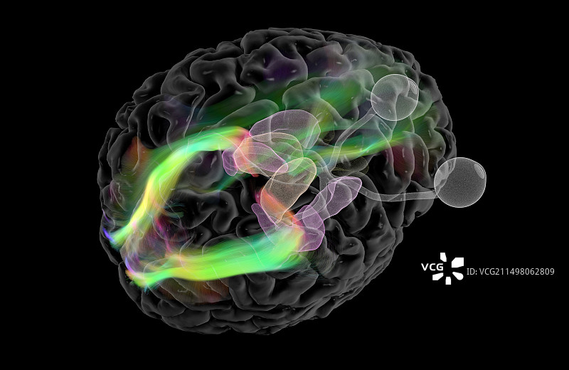 大脑视觉通路DTI核磁共振扫描图片素材