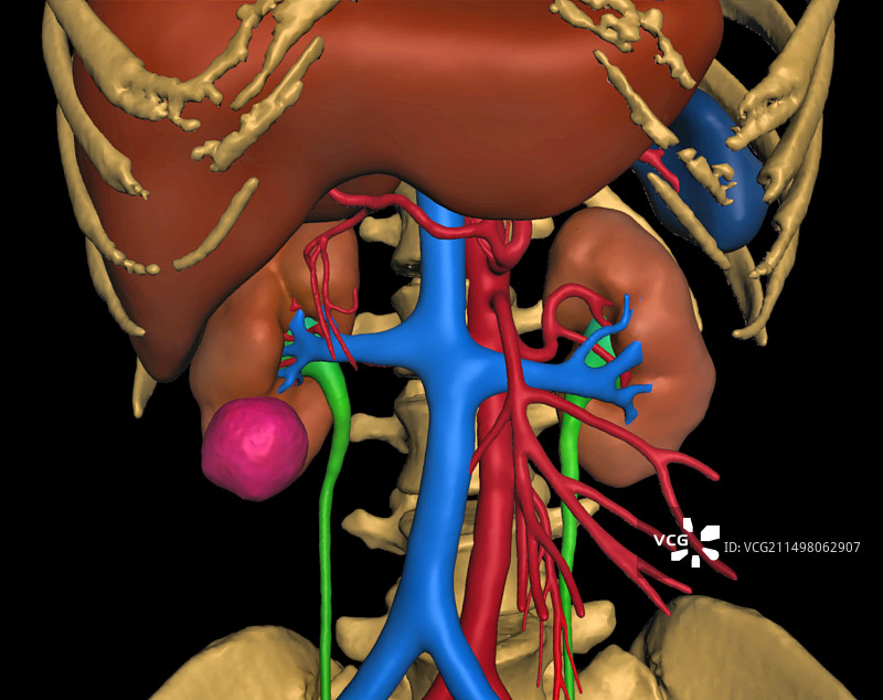 肾癌3D CT扫描图片素材