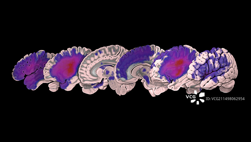 中风病灶分布核磁共振扫描图图片素材