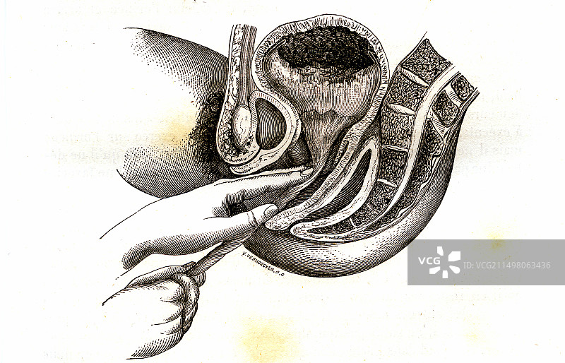 滞留胎盘，19世纪插图图片素材