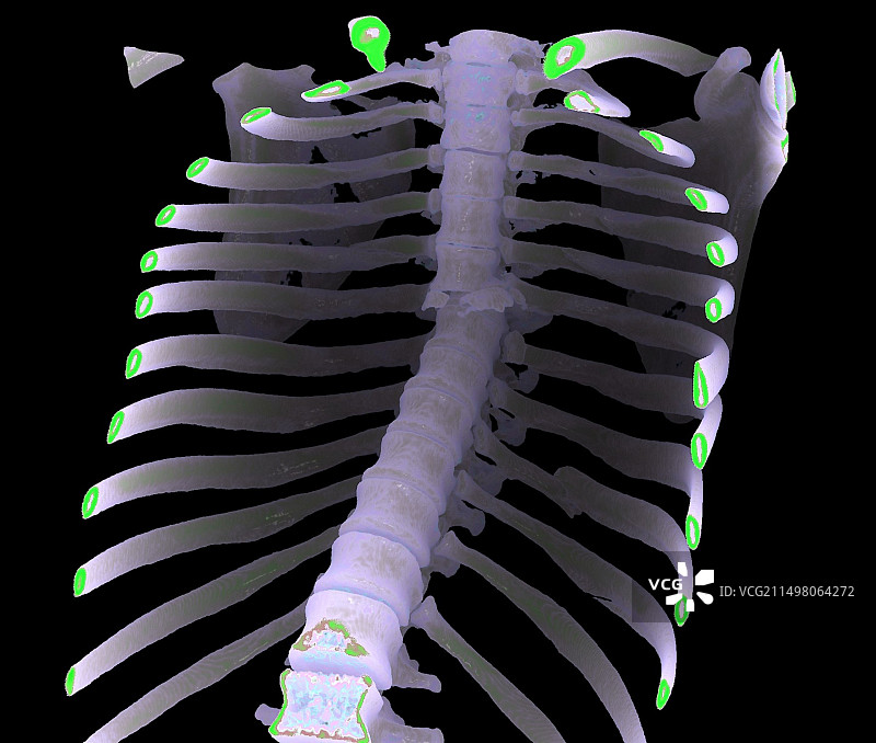 胸椎骨折CT扫描图片素材