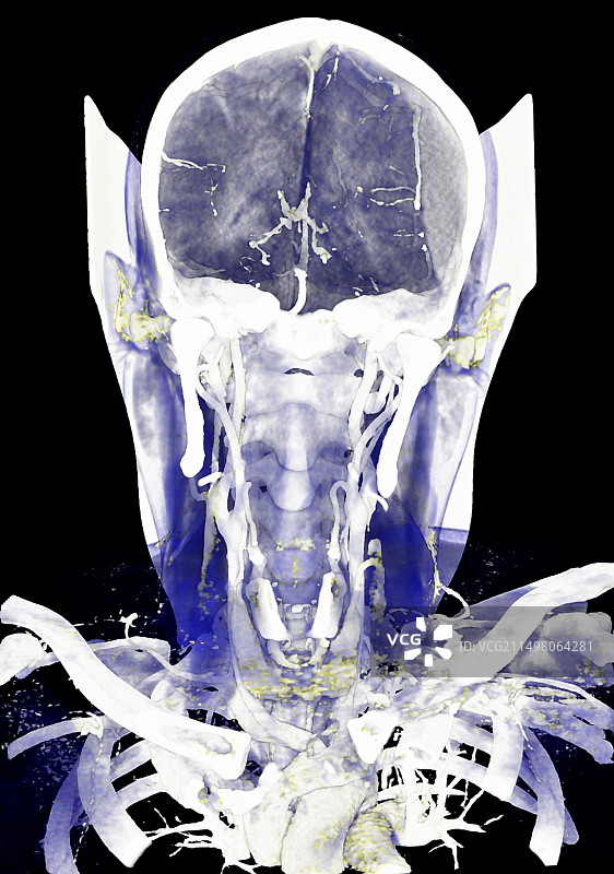 硬膜下血肿CT扫描图片素材