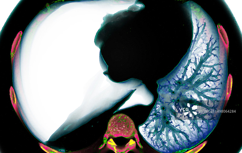 张力性气胸CT扫描图片素材