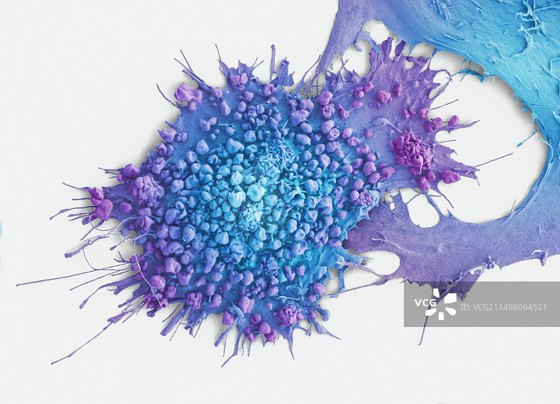 宫颈癌细胞，扫描电子显微镜图片素材