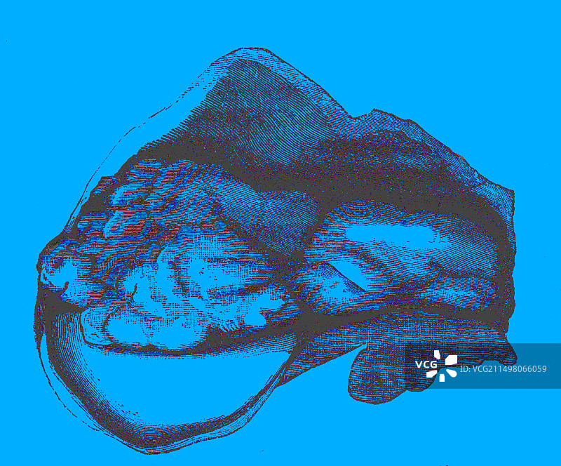 良性膀胱肿瘤，19世纪插图图片素材