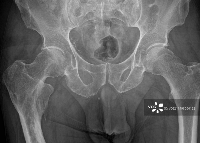髋关节骨关节炎X光片图片素材
