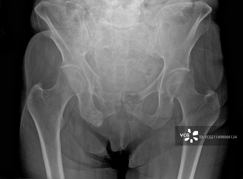 髋部骨折X光片图片素材