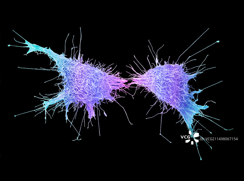 宫颈癌细胞分裂，扫描电镜图片素材
