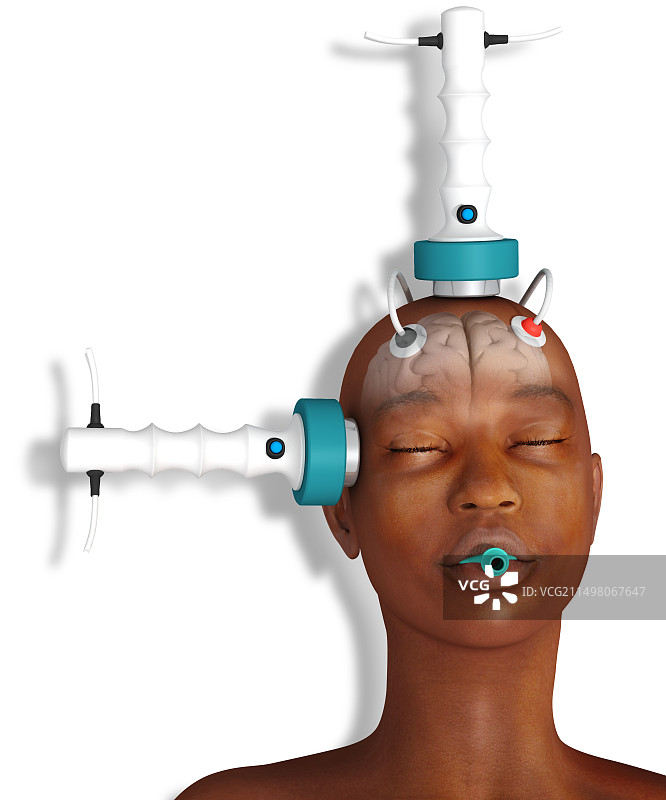 电休克疗法，插图图片素材