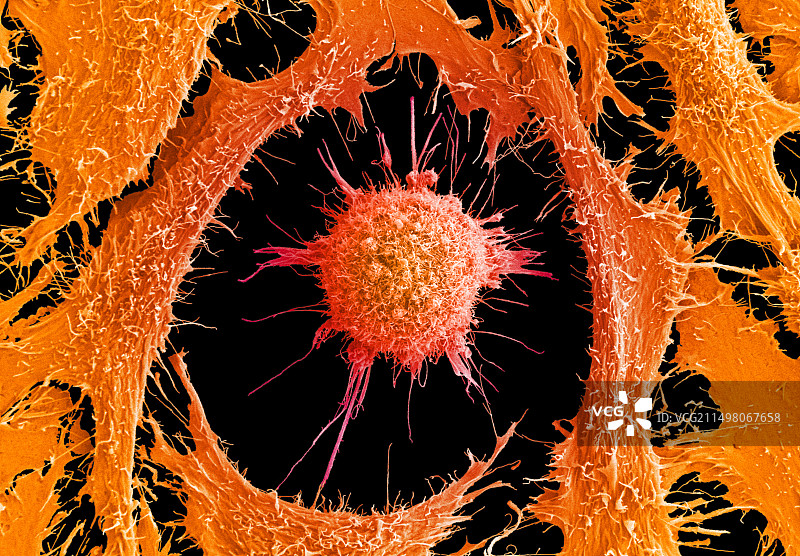 宫颈癌细胞，扫描电子显微镜图片素材