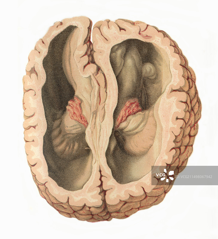 脑积水插图图片素材