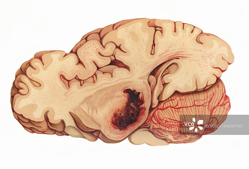 脑出血插图图片素材