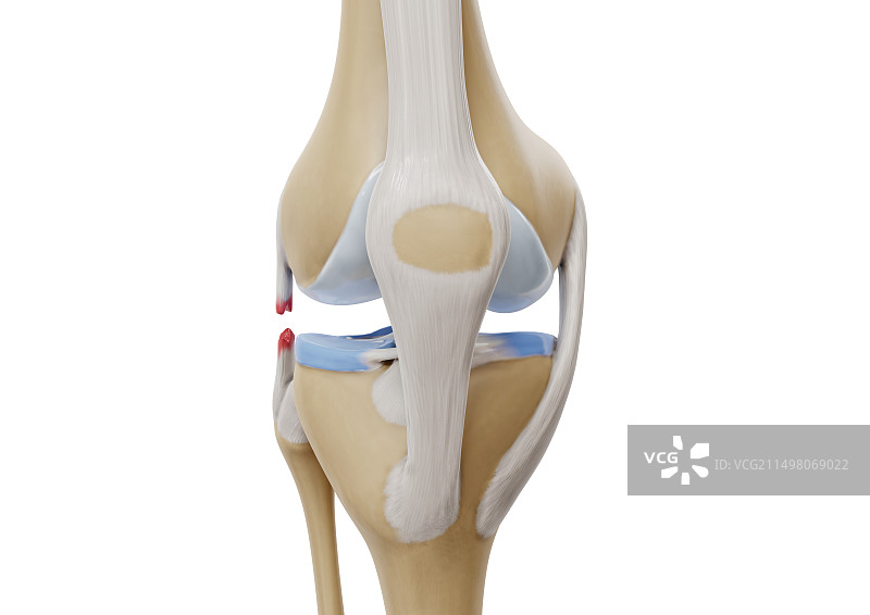 膝外侧副韧带撕裂插图图片素材