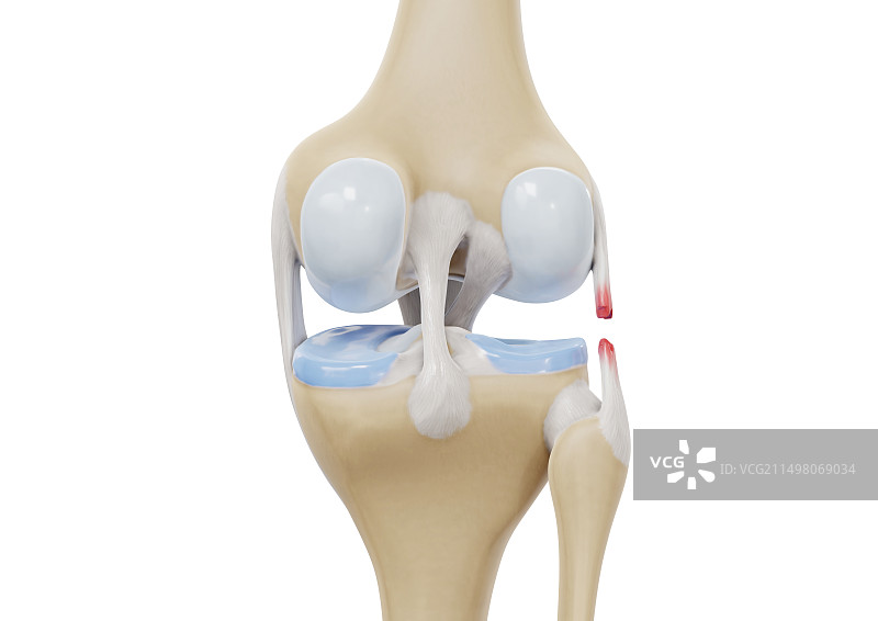 膝外侧副韧带撕裂插图图片素材