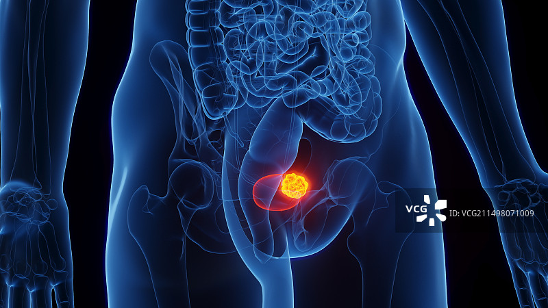 膀胱癌插图图片素材
