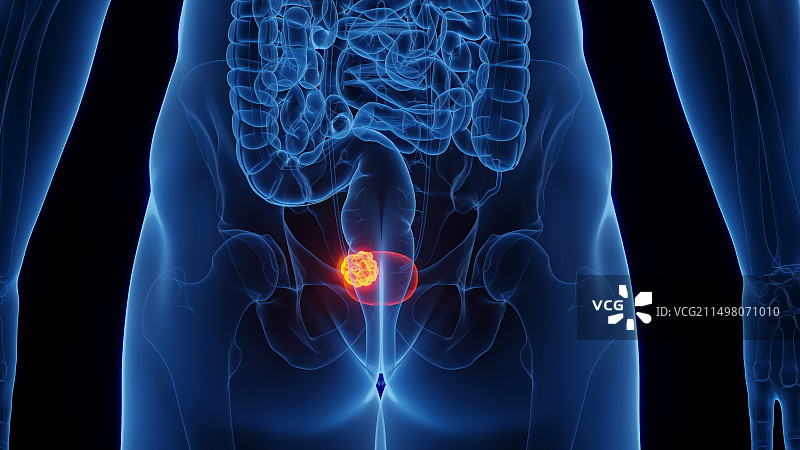 膀胱癌插图图片素材