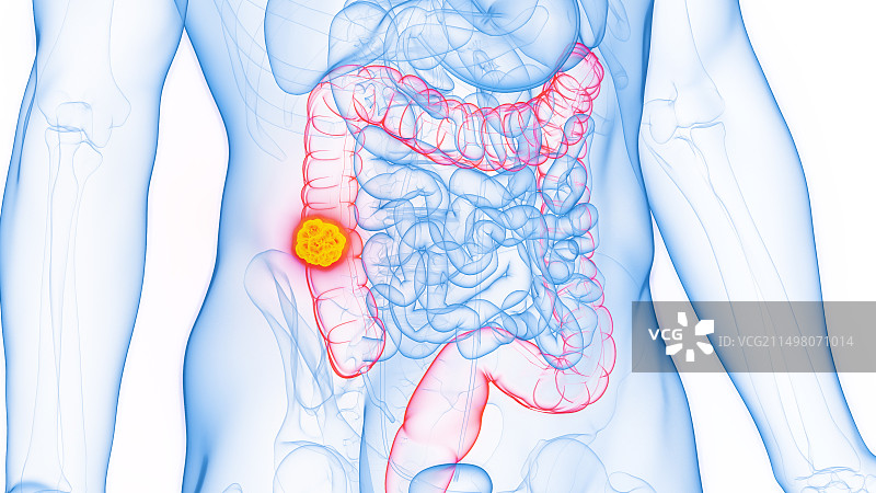 结肠癌，图示图片素材