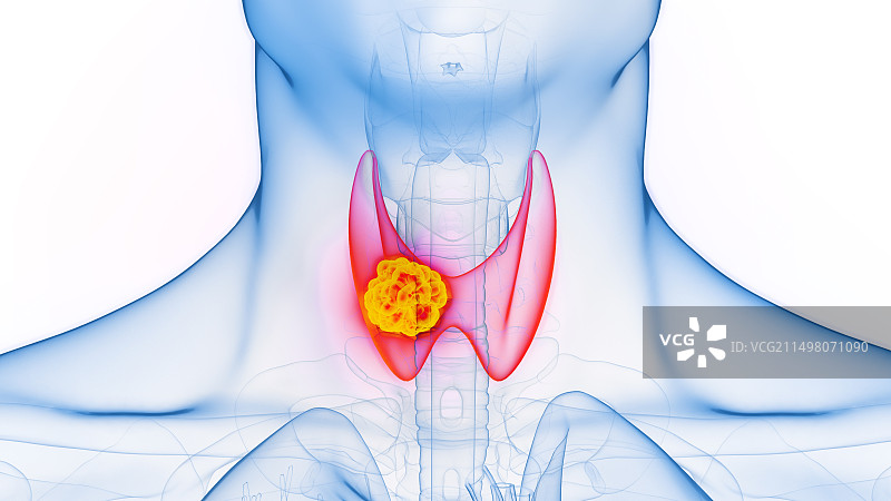 甲状腺癌图示图片素材