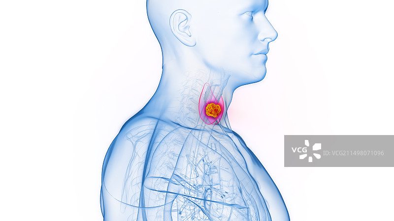 甲状腺癌图示图片素材