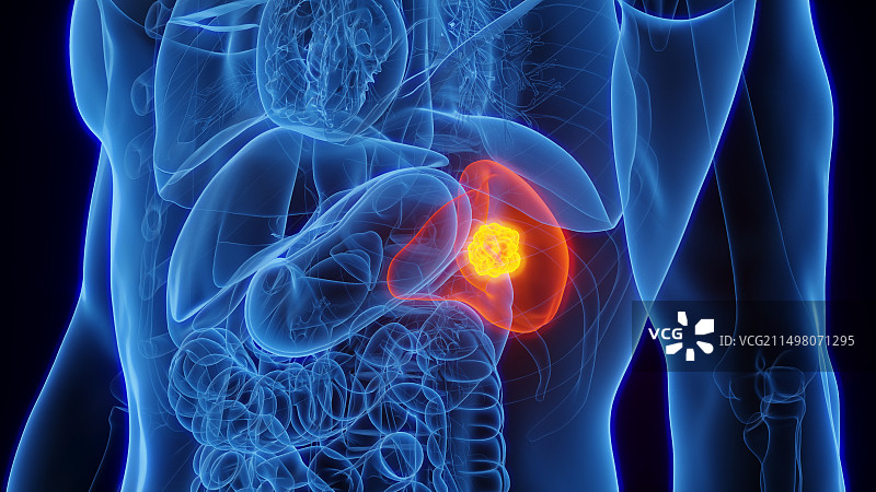 脾脏癌插图图片素材