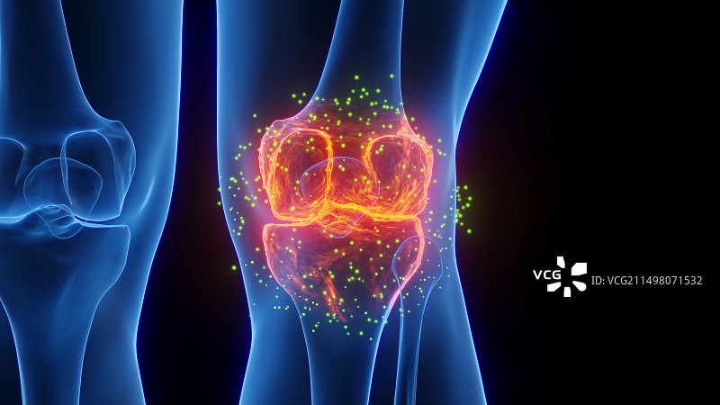 发炎的膝盖愈合插图图片素材