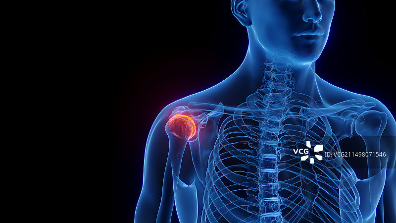 肩关节炎症插图图片素材