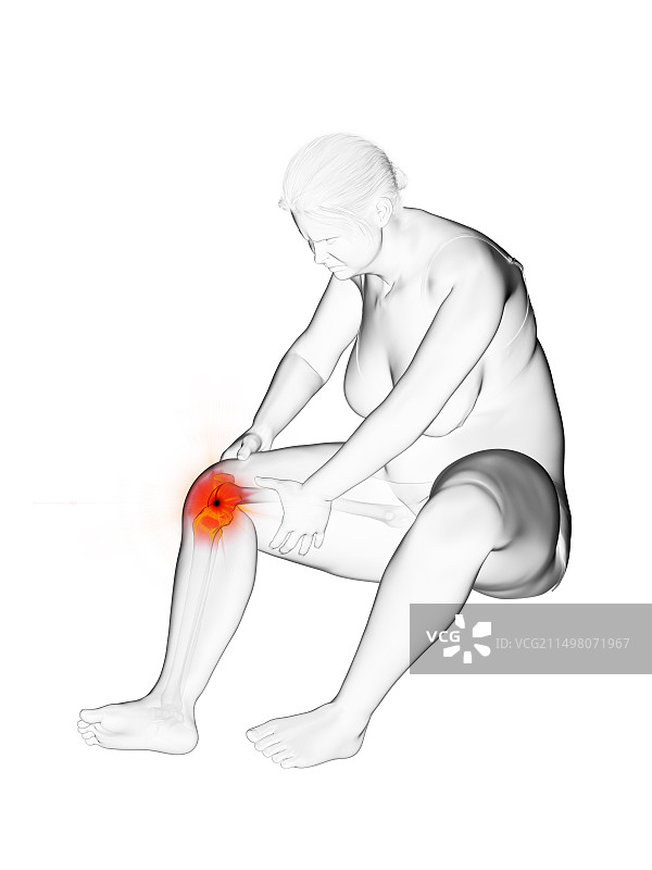 膝关节疼痛的超重妇女，插图图片素材